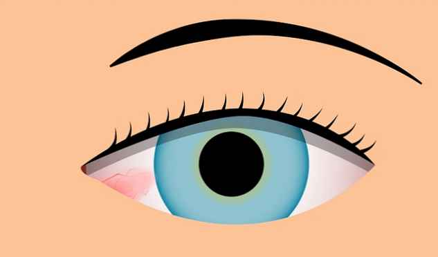 Ydeevne melodisk Merchandiser Hvad er og hvordan er behandlingen af ​​Pinguecula i øjet (oftalmologi) |  Alt om dit helbred!