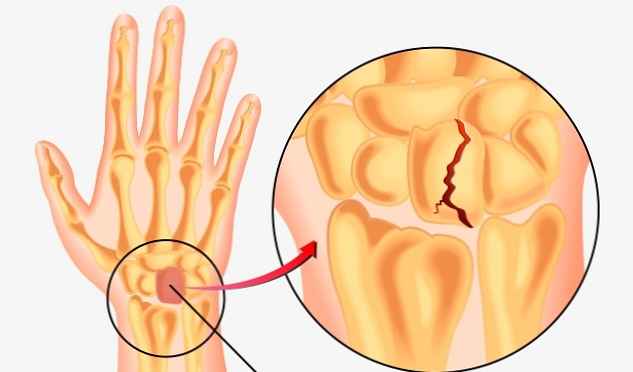 bolovi u zglobovima nakon crijevne infekcije