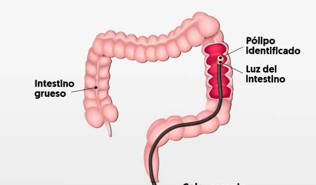 Como se hace una colonoscopia con sedacion